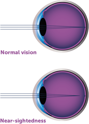 schaubild-kurzsichtigkeit